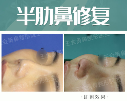 2020年上海鼻修复专家排名 2020年上海隆鼻医生预约排行榜