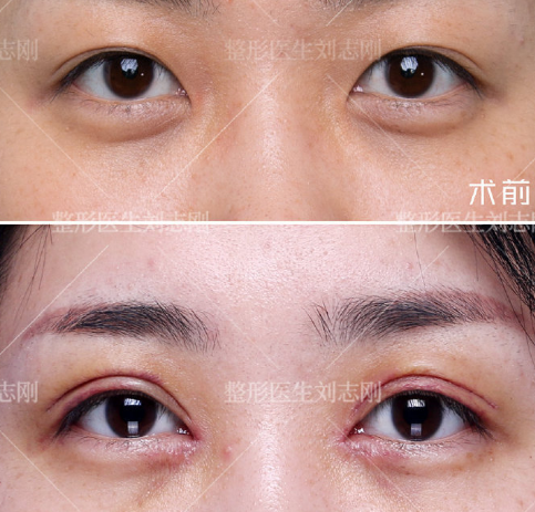 西安双眼皮修复最好的医生有哪些？