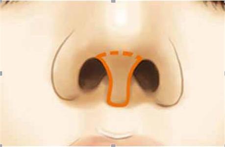 挛缩鼻畸形的原因是什么？挛缩鼻畸形怎么修复?