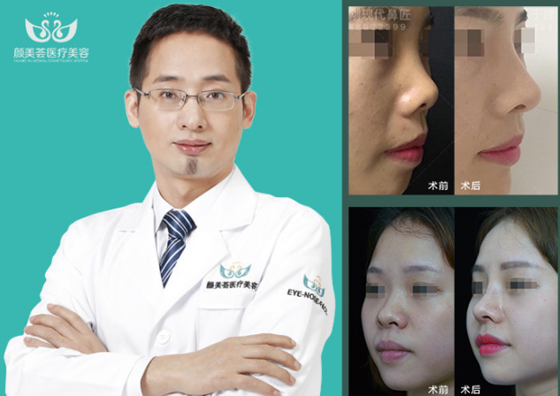 广州于建刚医生隆鼻技术怎么样？