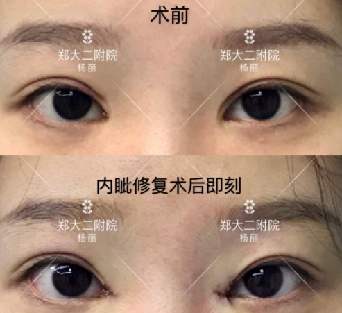 郑州双眼皮修复哪个医生比较好？