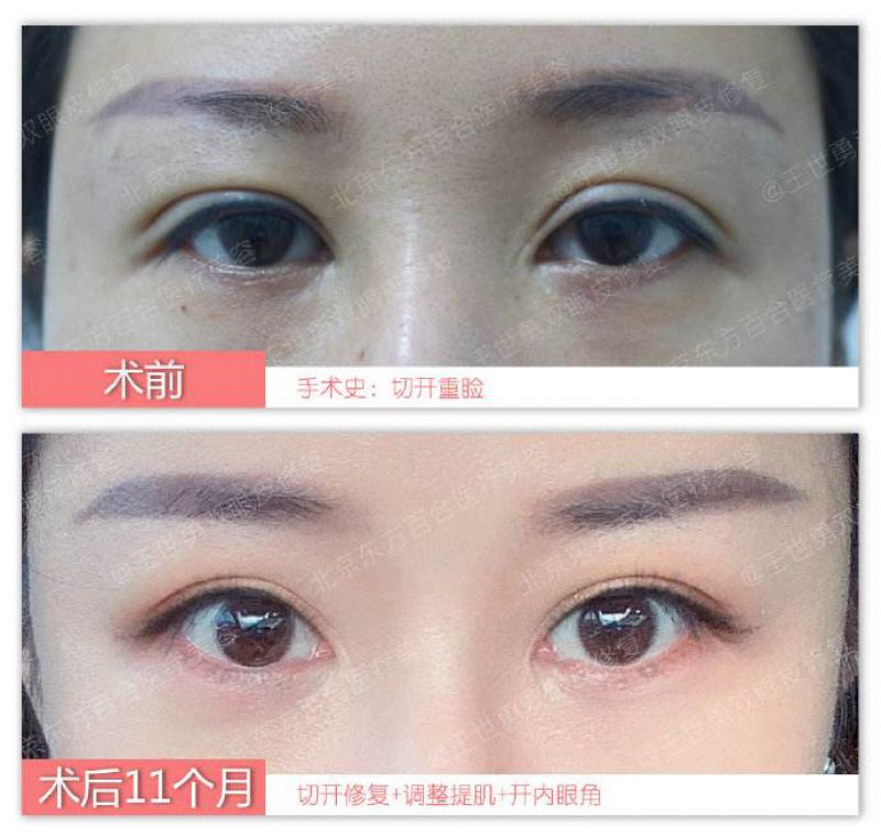 中国哪个医生眼睛修复得好？中国眼修复医生预约排名