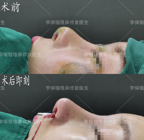 杭州鼻子修复最好的医生是谁？杭州鼻修复医生预约排名