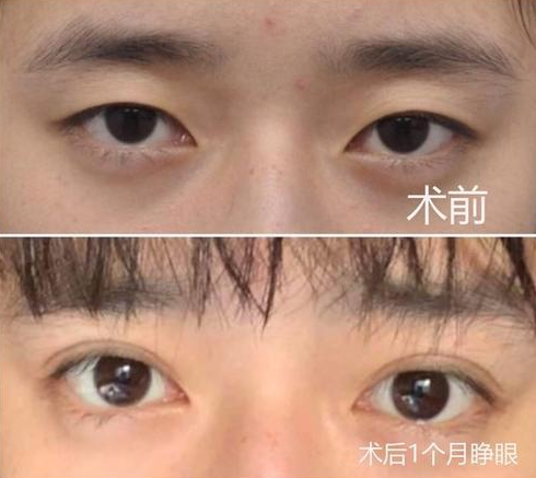武汉哪个医生做双眼皮修复好？