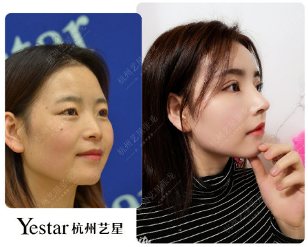 杭州最好的鼻子修复专家是谁？杭州鼻修复医生预约排名