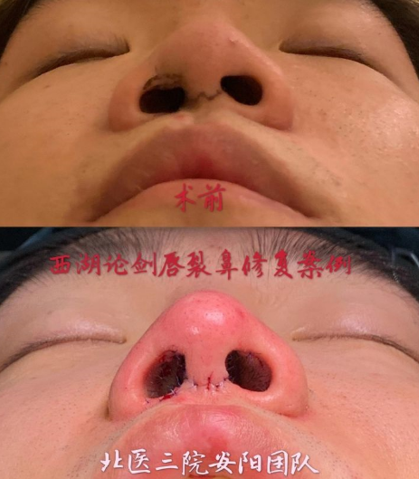 中国鼻修复专家哪个最厉害？鼻修复医生排名大全