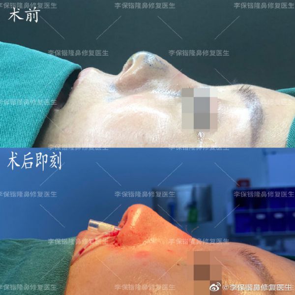 杭州修复鼻子最好的医生是哪个？杭州修复鼻子专家排名