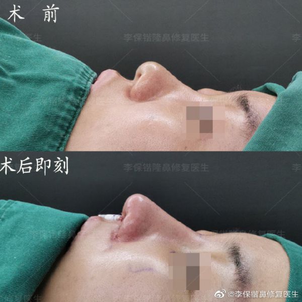 杭州鼻综合修复手术医生排名预约