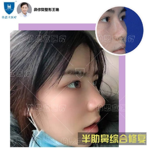 上海鼻部修复哪个医生最好？上海隆鼻修复专家预约排名