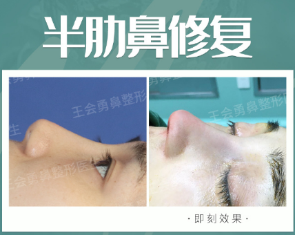 上海最好的鼻子修复医生预约排行榜大全