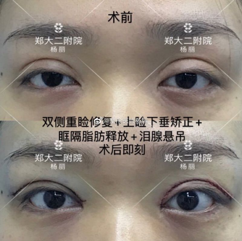 郑州修复双眼皮最好的医生是哪个？