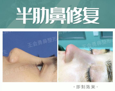 上海技术最好的鼻修复专家是谁？上海隆鼻修复预约排名