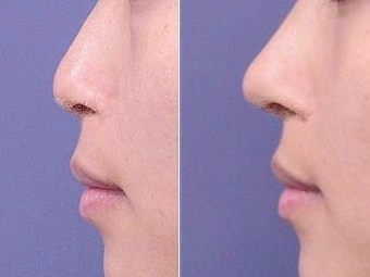 隆鼻有风险吗？隆鼻会产生哪些隆鼻后遗症？