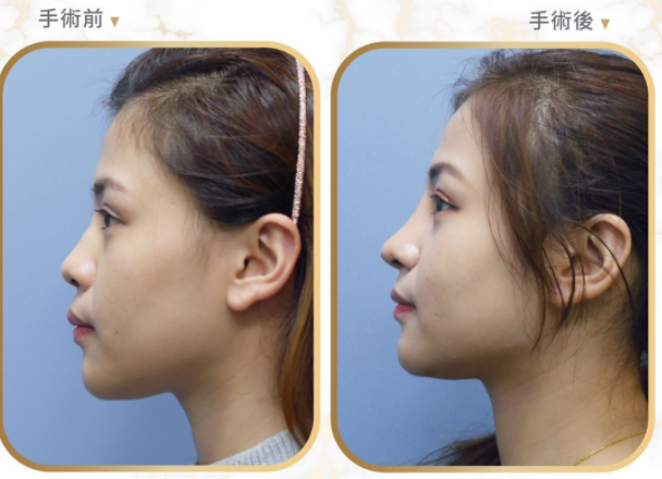L型硅胶隆鼻和硅胶隆鼻的优点是什么？