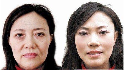 上海九院做面部提升拉皮哪个做得好？