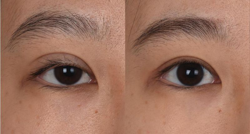 武汉有哪个修复双眼皮比较好的医生？