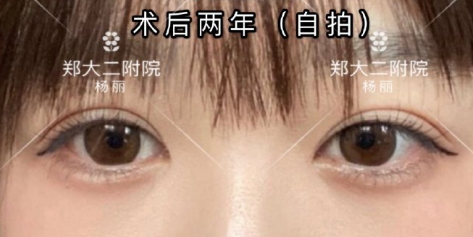 郑州杨丽和田国静哪个修复双眼皮最好？