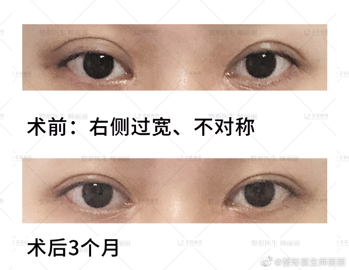 郑永生师丽丽哪个修复双眼皮技术更厉害？