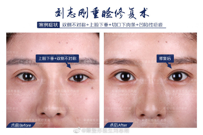 刘志刚和刘风卓眼睛修复哪个好？