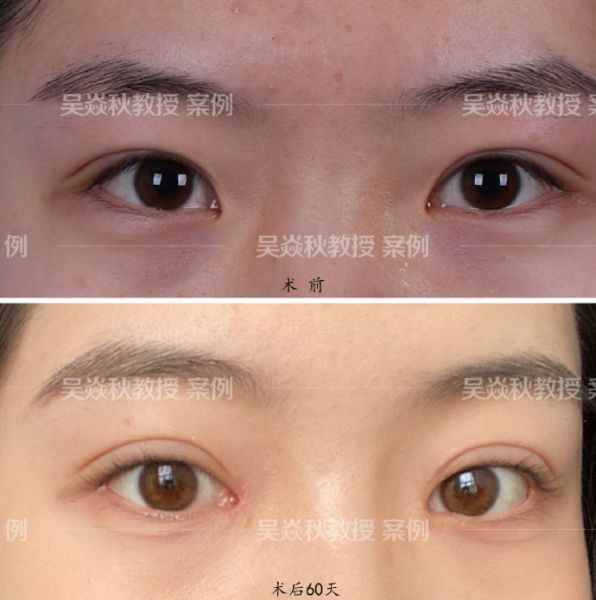 北京眼修复最好的专家是谁？北京做双眼皮修复谁最好？
