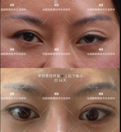 中国修复双眼皮技术最好的医生是谁？