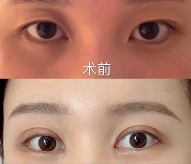 上海九院眼科开双眼皮哪个医生技术好？