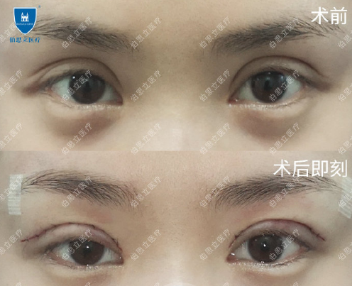 沈国雄和徐晓斐哪个修复双眼皮技术更好？