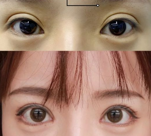北京双眼皮修复比较权威的医生有哪些？