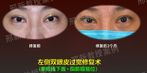 上海有名的双眼皮修复专家有哪些？