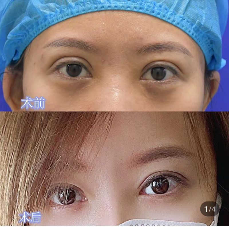 西安孙峰修复双眼皮的技术怎么样？