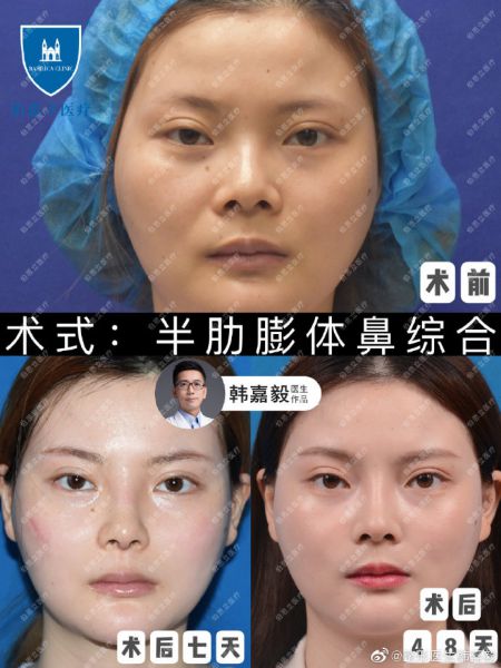 上海做鼻子专家谁最好？上海隆鼻医生前十名