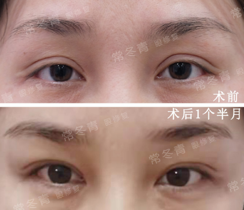 北京常冬青修复双眼皮技术到底咋样？