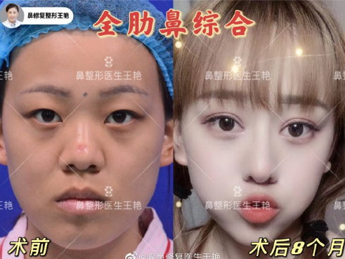 上海最权威鼻子整形医生是哪位？上海隆鼻预约前十名