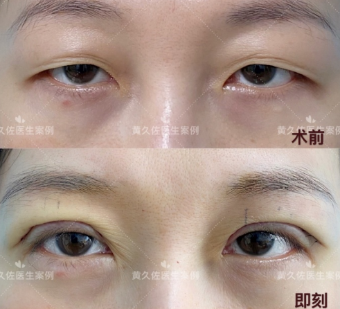 北京协和黄久佐做的双眼皮技术怎么样？