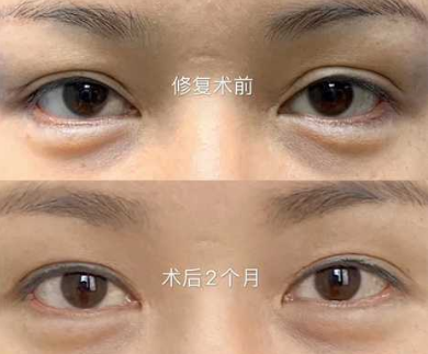 长春双眼皮修复哪个医生做的技术更好？