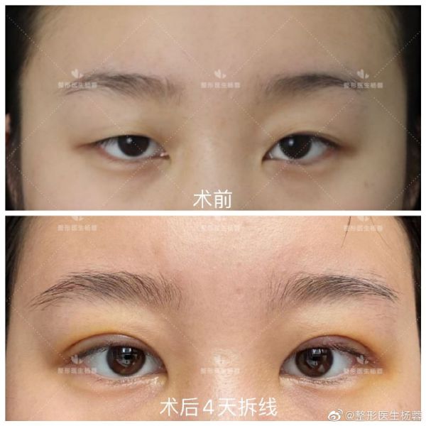 武汉武昌铁路医院杨蓉做双眼皮和修复怎么样？