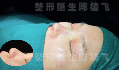 向宏伟和陈桂飞对比哪个医生做鼻子技术好？