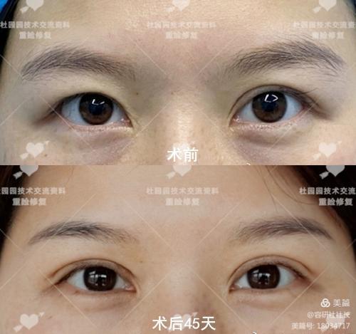 上海杜园园做双眼皮修复技术真的好吗？
