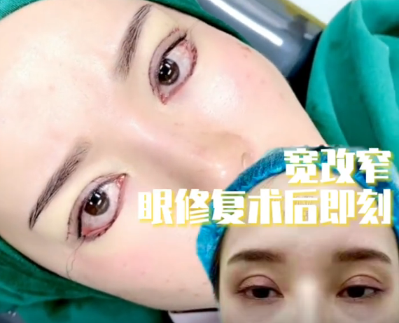 台湾魏少魁医生双眼皮修复技术怎么样？