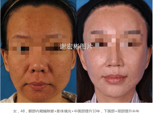 谢宏彬和祝东升谁做的面部大拉皮手术技术更好？