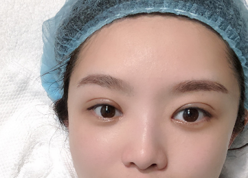 2022年天津哪个医生修复双眼皮技术最好？
