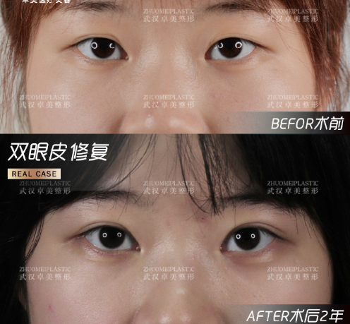 武汉王海平双眼皮修复技术做的好吗？