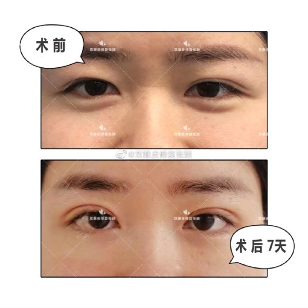 北京美莱张颖双眼皮修复技术口碑怎么样？