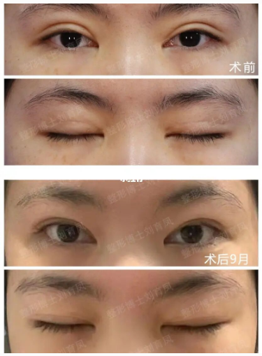南京二院刘育凤和刘宁谁做双眼皮修复技术好？