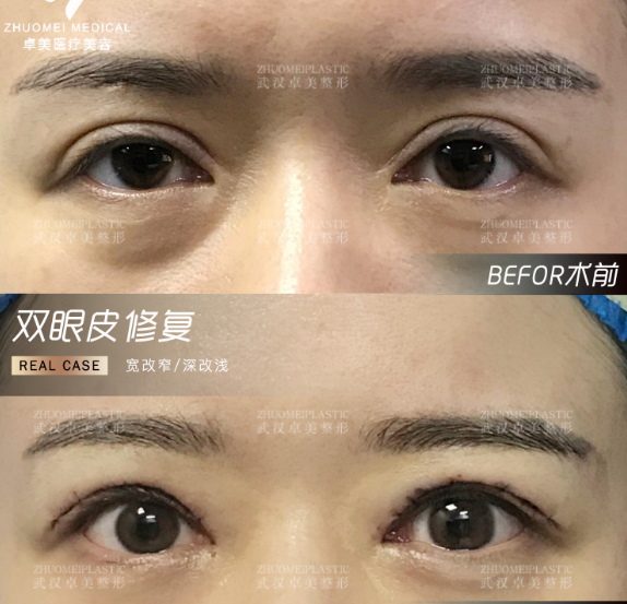 武汉王海平和吴小蔚哪个双眼皮修复最好？