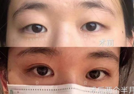 上海九院王俊芳割双眼皮技术怎么样？