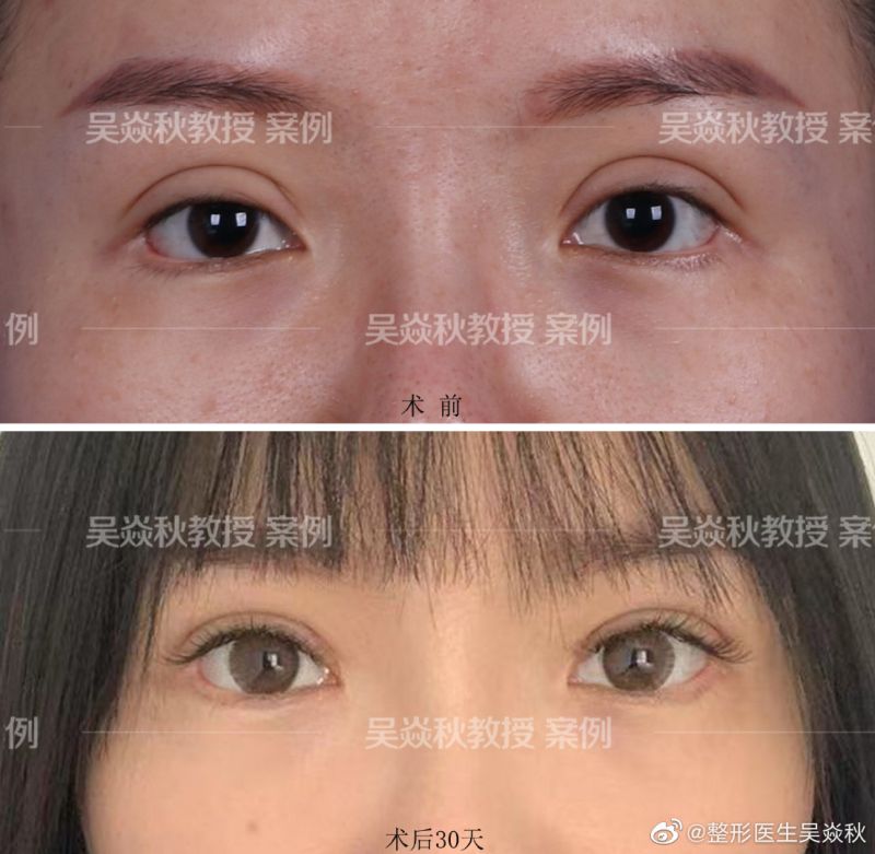 吴炎秋和刘风卓哪个修复双眼皮技术好？