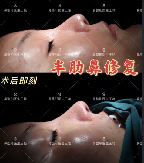 2022年上海鼻修复哪个医生好？上海鼻修复预约排名