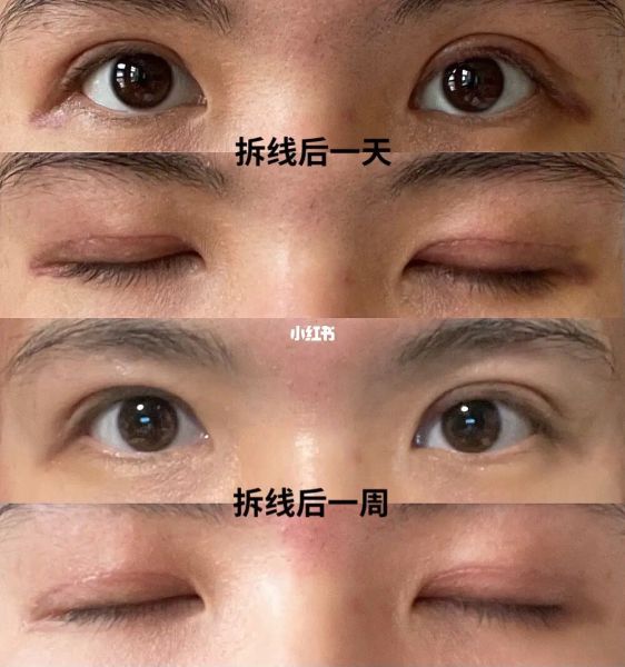 2022年北京八大处哪个医生双眼皮手术最好？