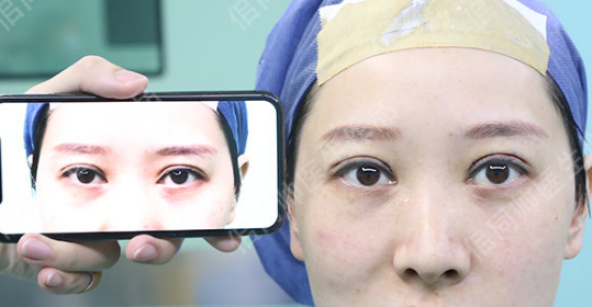 上海华美佀同帅双眼皮修复技术怎么样？